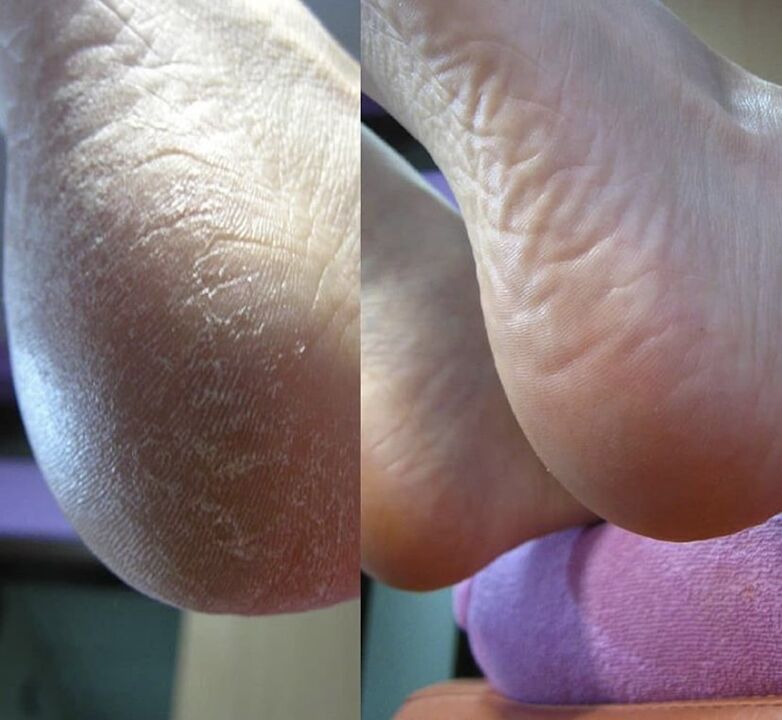 Foto der Ferse des Fußes vor und nach der Anwendung der Creme Zenidol