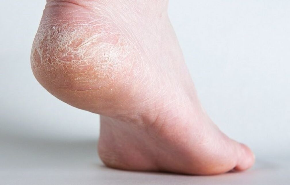 Hautpilz am Bein, wie man behandelt