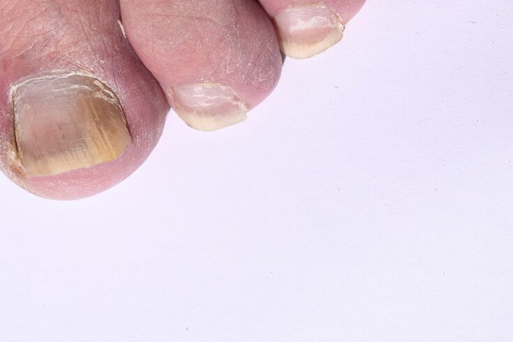 Die anfängliche Stufe der Nagelmykose an den Beinen