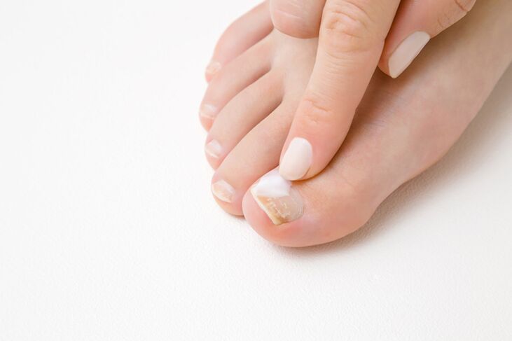 Fingbehandlung mit Pilzsalbe