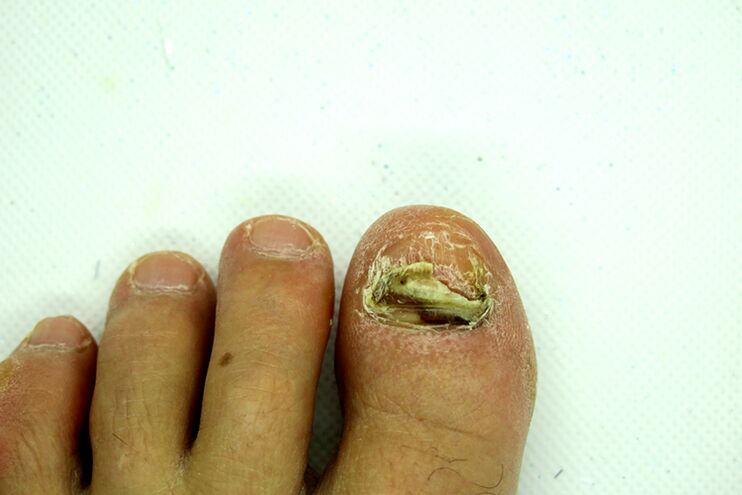 Fingerpilz - Schwere Stufe