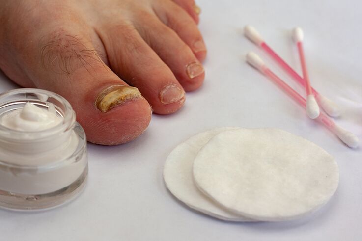 Pilzpilzbehandlung mit Pilzcreme
