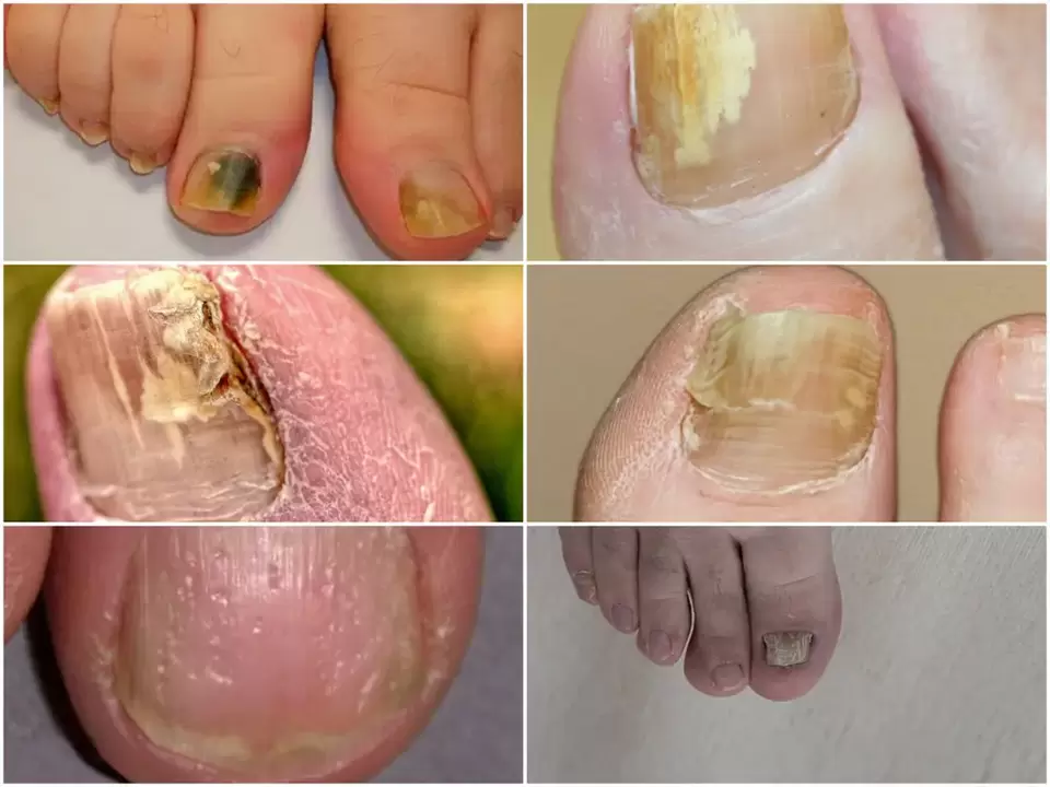 Symptome einer Onychomykose sind Veränderungen in der Farbe und Struktur der Nägel.